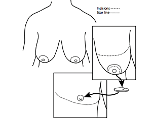 Double Incision Top Surgery