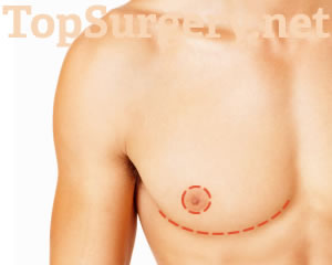 Double Incision Top Surgery